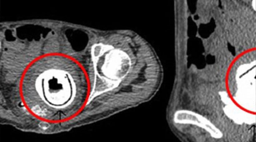 Ένα «sex toy» βρισκόταν στον κόλπο της για... δέκα χρόνια! - Media