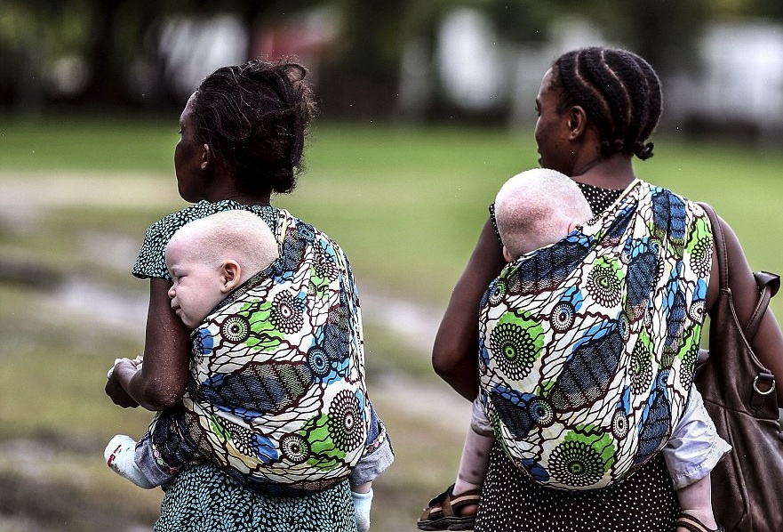 Σε ποια χώρα τα παιδιά-αλμπίνοι, κινδυνεύουν με θάνατο (Photos) - Media