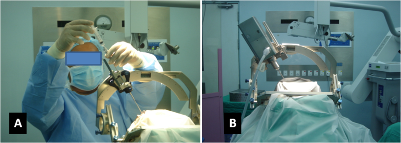 Δείτε επέμβαση σε Έλληνα ασθενή, που υποβάλλεται σε βιοψία εγκεφάλου ξύπνιος - Media