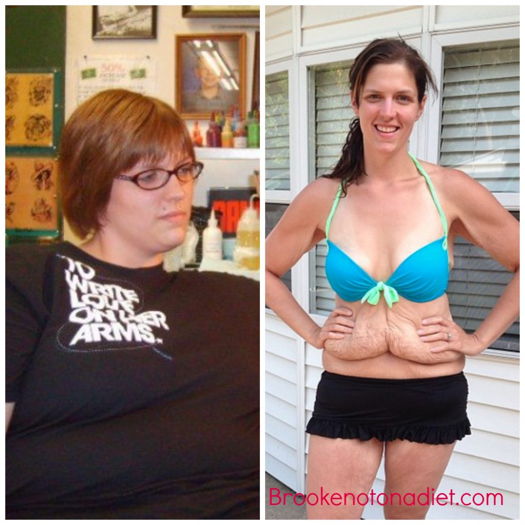 Έτσι γίνεται το κορμί, όταν χάσουμε ξαφνικά 78 κιλά (photo) - Media