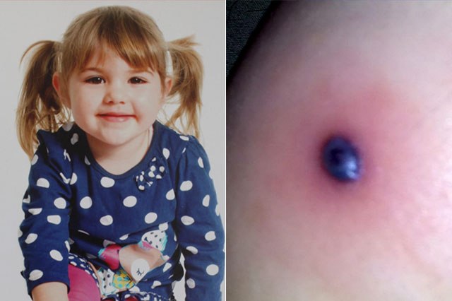 Το δάγκωμα ενός κουνουπιού έσωσε ένα τρίχρονο κοριτσάκι από τον καρκίνο - Media
