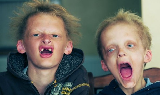 Σπάνια ασθένεια κάνει 2 αδερφάκια να μοιάζουν με βαμπίρ (Video) - Media