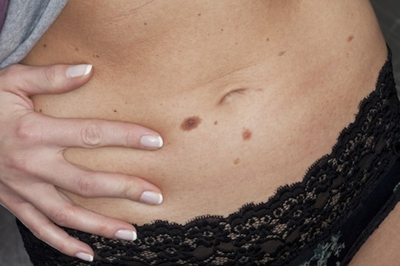 Δείτε σε φωτογραφίες, πώς πρωτοεμφανίζεται ο καρκίνος του δέρματος - Media
