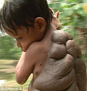 Η ιστορία του «παιδιού-χελώνα» με το τεράστιο καβούκι στην πλάτη του (Video) - Media