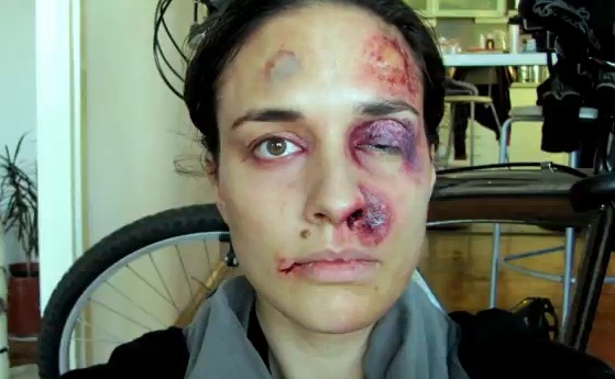 Η ενδοοικογενειακή βία αποτυπωμένη στο πρόσωπο μιας γυναίκας
 - Media