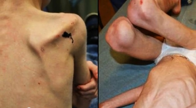 Τα κοκαλάκια του, του τρύπησαν την πλάτη από την ασιτία - (VIDEO) - Media