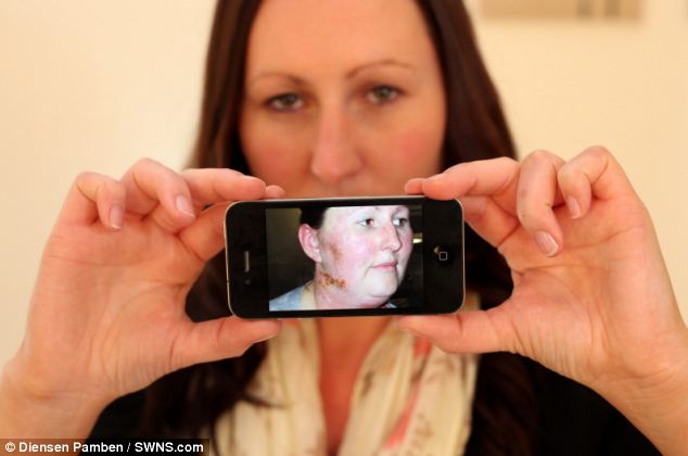 Τα κινητά τηλέφωνα προκαλούν 37 είδη αλλεργικής δερματίτιδας στο πρόσωπο
  - Media