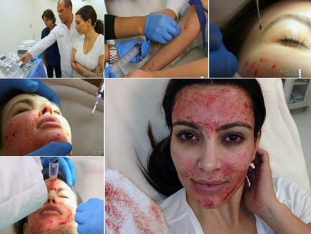 Vampire Lift: Όταν το δέρμα σας διψάει για αίμα… Δείτε φωτογραφίες με επώνυμες, να κάνουν αναγέννηση προσώπου με… αιμοπετάλια! - Media