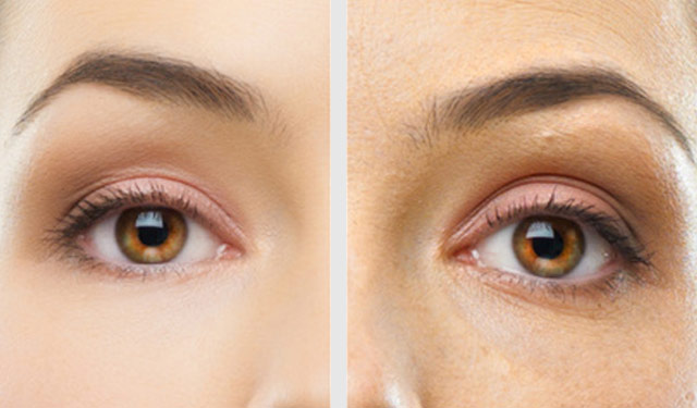 Βλεφαροπλαστική χωρίς νυστέρι…για γυναίκες και άνδρες - Media