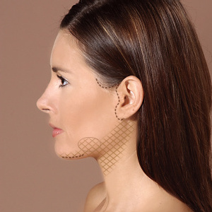 Ανόρθωση λαιμού (neck lift) με τη χρήση βλαστοκυττάρων - Media