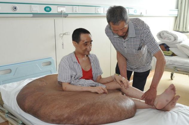 Αυτός είναι ο μεγαλύτερος όγκος που αφαιρέθηκε ποτέ από άνθρωπο - Ζύγιζε 110 κιλά (Photo) - Media