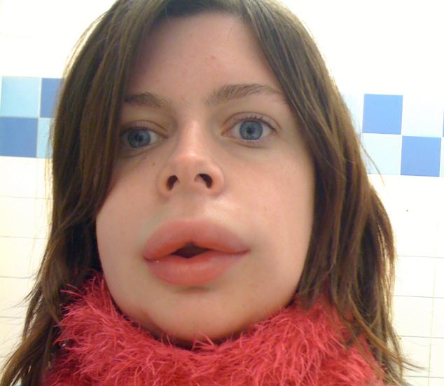 Σπάνια ασθένεια τη μεταμορφώνει σε ένα ζωντανό μπαλόνι (Photos) - Media