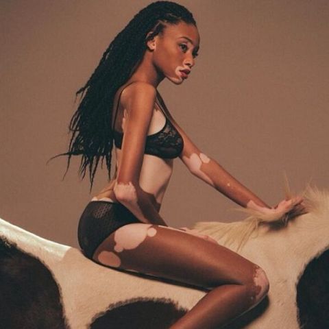 Δείτε το top-model με τη σπάνια δερματική πάθηση  - Media