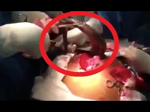 Οι αντιδράσεις των φοιτητών όταν καθηγητής αφαιρεί ένα ζωντανό ψάρι από το έντερο ασθενούς (Video) - Media