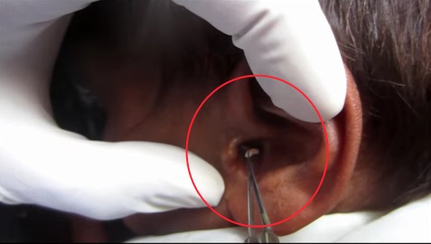 Δείτε τι ζούσε μέσα στο αυτί του- Τι τραβάνε και οι ΩΡΛάδες; VIDEO - Media