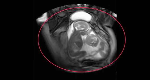 Έχετε δει δίδυμα να μαλώνουν μέσα στην κοιλιά της μητέρας τους; (Video) - Media