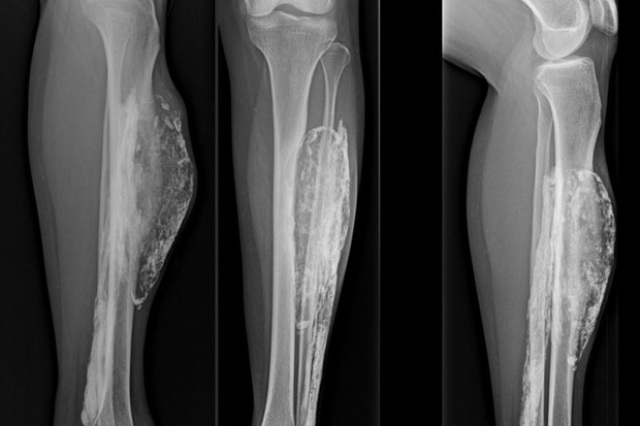 Δείτε πως έγινε το πόδι μιας γυναίκας που την δάγκωσε φίδι, πριν από 50 χρόνια(ΦΩΤΟ) - Media