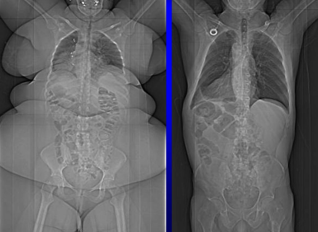 Δείτε ακτινογραφίες υπέρβαρων ανθρώπων - Δεν θα πιστεύετε στα μάτια σας - Media