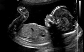 Γυναικολόγος έκανε άμβλωση σε 40χρονη που δεν ήταν έγκυος για 800 ευρώ - Media