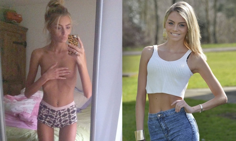 Η ανορεξική έφηβη που έτρωγε μόνο 1 μήλο τη μέρα, μεταμορφώθηκε σε βασίλισσα της ομορφιάς (Photos) - Media