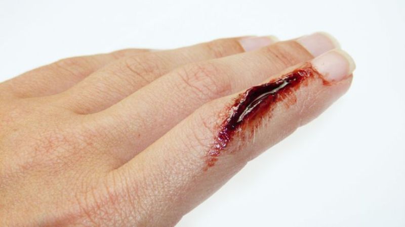 Τι πρέπει να κάνουμε σε περίπτωση που κοπούμε και το αίμα δεν σταματάει (Video) - Media