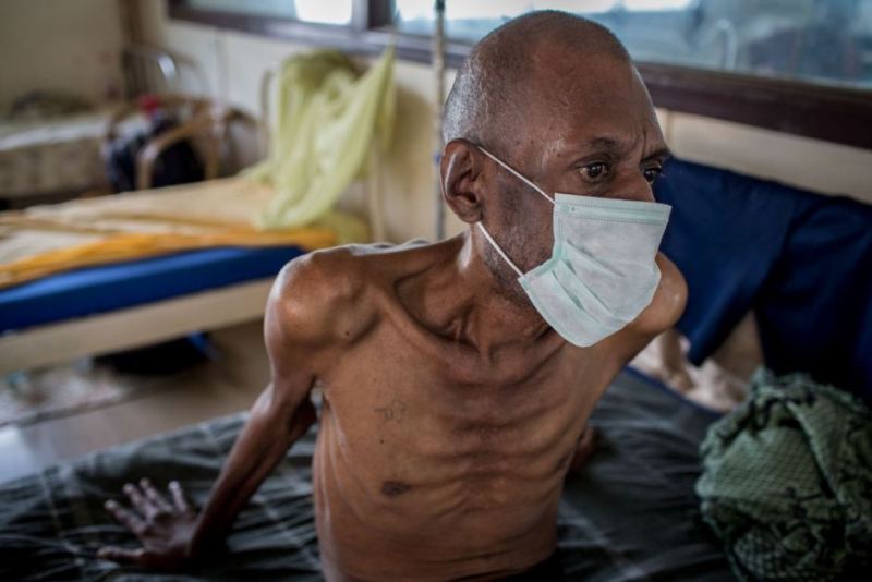 Φυματίωση: ο εφιάλτης είναι ακόμη εδώ - Tα σημάδια που πρέπει να προσέξετε - Media