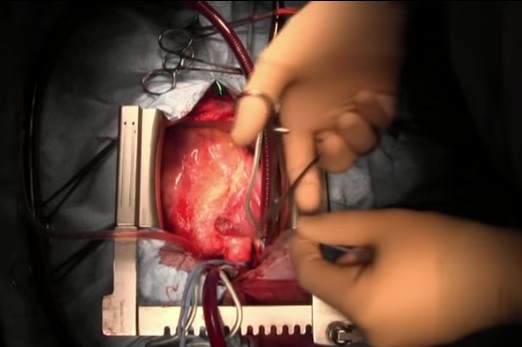 Εκπληκτικό: δείτε πως γίνεται μια μεταμόσχευση καρδιάς (Video) - Media