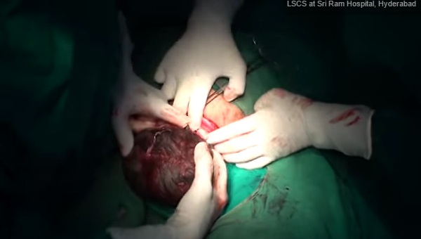 Έχετε δει ποτέ γέννηση με καισαρική τομή; (Video) - Media