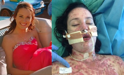 19χρονη «βασίλισσα της ομορφιάς» πεθαίνει από λάθος φάρμακα - καίγεται το δέρμα της - Media