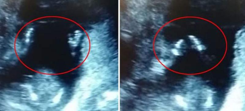 Το βίντεο που έγινε viral στο Διαδίκτυο: Έμβρυο χτυπά παλαμάκια μέσα στην κοιλιά της μητέρας του! - Media