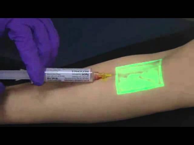 Δείτε τη νέα τεχνολογία, που θα σας διώξει το φόβο της βελόνας στην αιμοληψία (Video) - Media