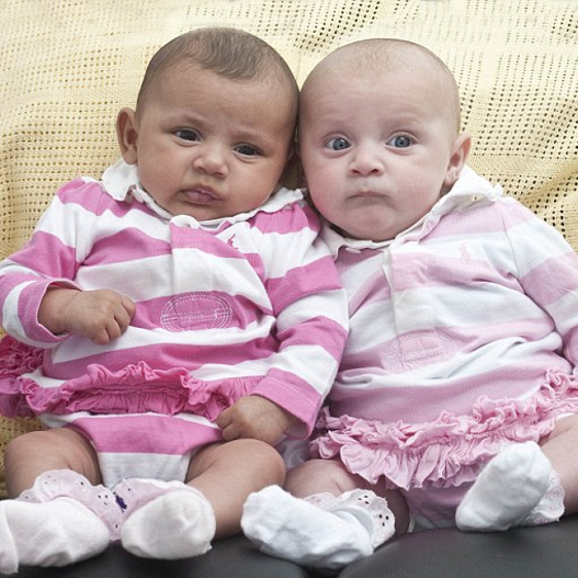 Μάθετε για τα νεογέννητα δίδυμα κοριτσάκια που έχουν… διαφορετικό χρώμα (Photos) - Media
