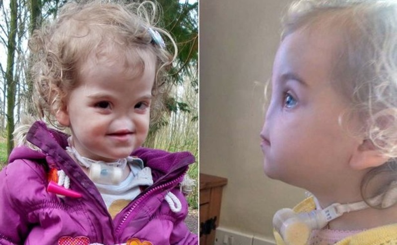 Δείτε το μωράκι που γεννήθηκε χωρίς μύτη- Τι σκέφτηκαν οι γιατροί για να την αποκαταστήσουν; (Photos) - Media