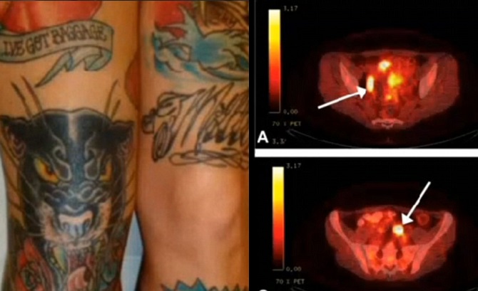 Η γυναίκα με τα τατουάζ, που χειρουργήθηκε κατά λάθος για μεταστατικό καρκίνο - Media
