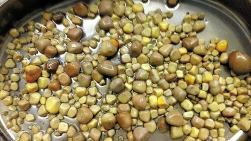 420 πέτρες αφαίρεσαν οι γιατροί από τα νεφρά ασθενούς- Τι έτρωγε και τις γέννησε ο οργανισμός του; - Media