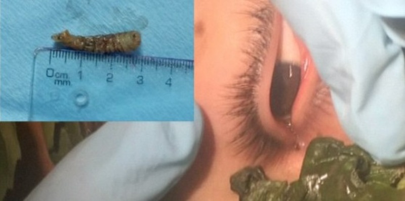 Δείτε πως οι γιατροί αφαίρεσαν με… φύλλα βασιλικού, ένα σκουλήκι από το μάτι ενός 17χρονου (Video) - Media