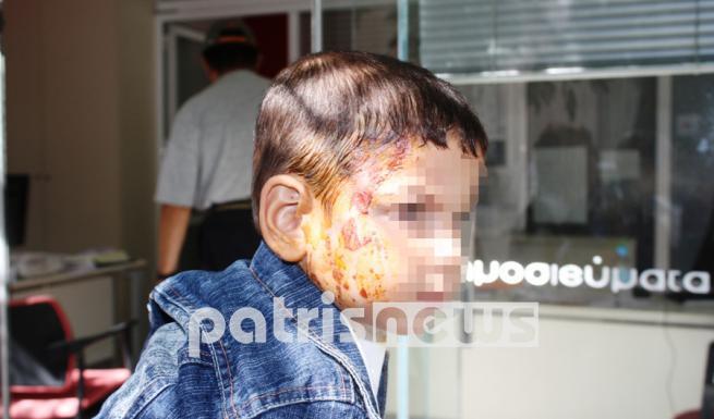 Έγκαυμα από ήλιο: Αυτά είναι τα σωστά βήματα για θεραπεία και ανακούφιση (Video) - Media
