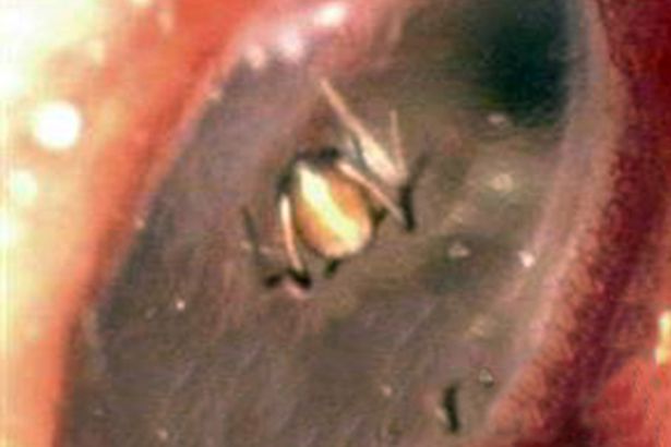 Άκουγε ήχους, πόναγε, νόμιζε ότι ήταν δαιμονισμένη, αλλά κάτι πολύ πιο ρεαλιστικό είχε «κάνει κατάληψη» στο αυτί της - Media