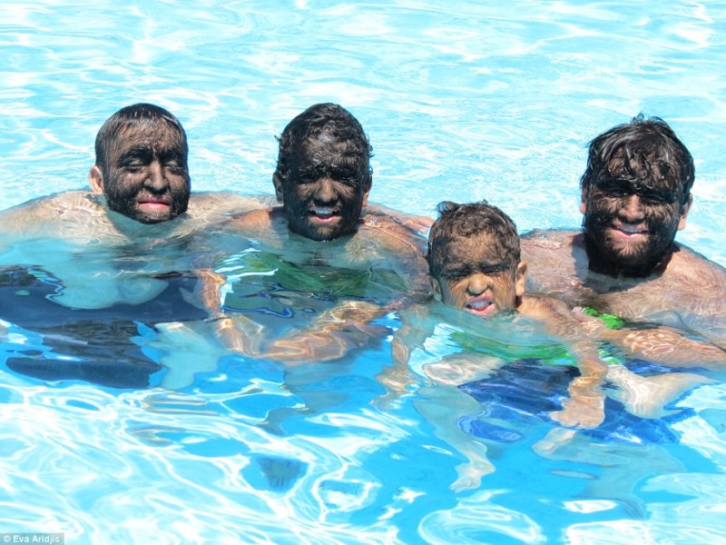 Οικογένεια «λυκανθρώπων»: φοβούνται να κυκλοφορήσουν στο δρόμο, ο κόσμος τους επιτίθεται και τους βρίζει (Video & Photos) - Media