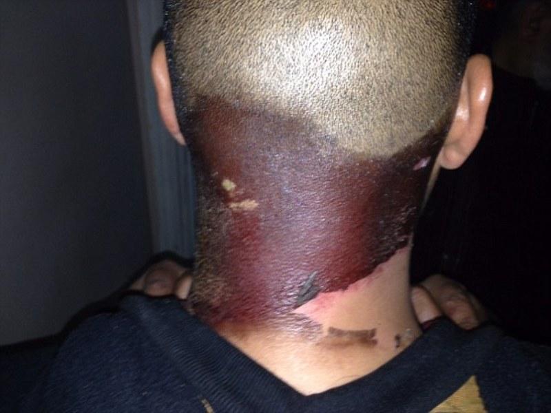 Η επίθεση των αραχνών: Τσιμπούν ανελέητα κόσμο στην Αγγλία- Δείτε πως έγινε ένας άνδρας (Video & Photos)  - Media