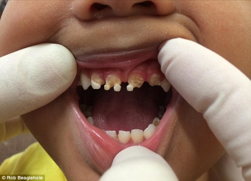 Προσοχή: Δείτε τι μπορεί να πάθουν τα δόντια των παιδιών όταν πίνουν αναψυκτικά με ζάχαρη (Photos) - Media