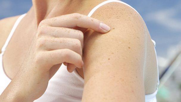 Πότε οι ελιές στον μπράτσο «δείχνουν» αυξημένο κίνδυνο για καρκίνο του δέρματος; - Media