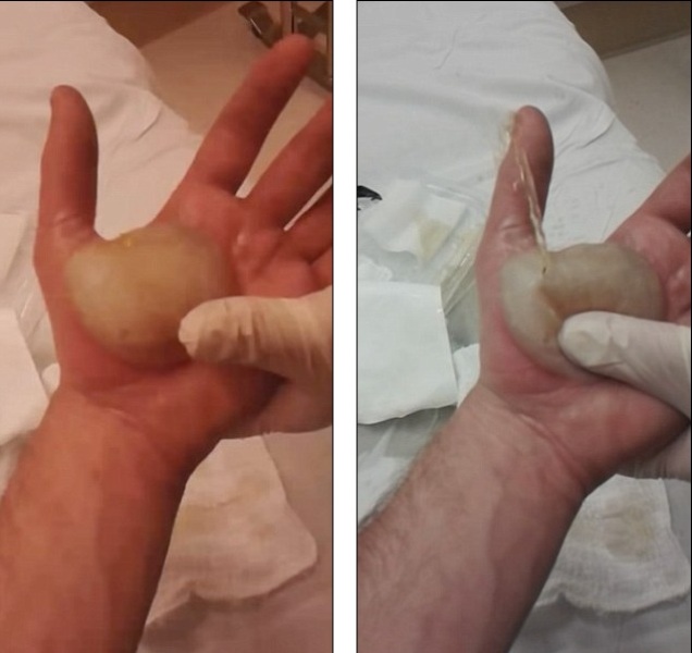 Γιατρός «σπάει» σε ασθενή μια τεράστια φουσκάλα που είχε σχηματιστεί στο δέρμα του (Video) - Media
