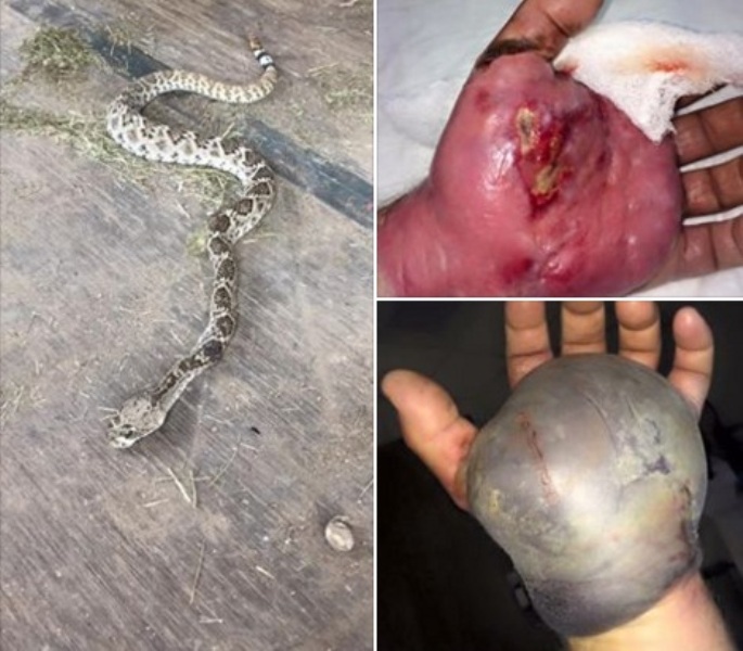 Ποιος τραγουδιστής σκότωσε κροταλία που δάγκωσε το χέρι φίλου του, και το χέρι έγινε έτσι; Σκληρές φωτογραφίες - Media