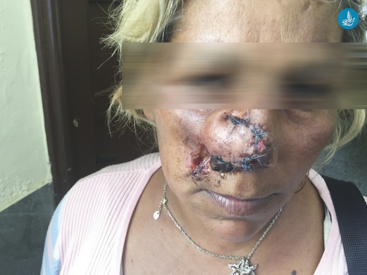 Απίστευτο περιστατικό στη Ρόδο: Την έδειραν και της έκοψαν τη μύτη - Media