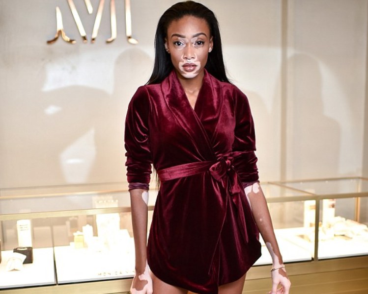 Έχει λεύκη και κατάφερε να κάνει καριέρα στο μόντελινγκ (Photos) - Media