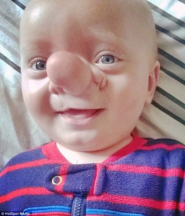 «Ο Πινόκιο της πραγματικής ζωής» - Το παιδί που ο εγκέφαλός του αναπτυσσόταν στη μύτη (Photos) - Media