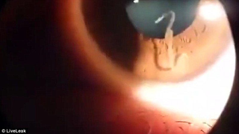 Ανατριχιαστικό: Ένα… σκουλήκι ζει στο μάτι αυτής της γυναίκας! (Video) - Media