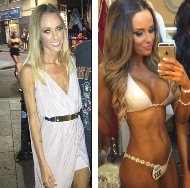 Η εκπληκτική  αλλαγή μιας ανορεξικής γυναίκας σε πληθωρική σεξοβόμβα που κέρδισε σε διαγωνισμό μπικίνι  - Media