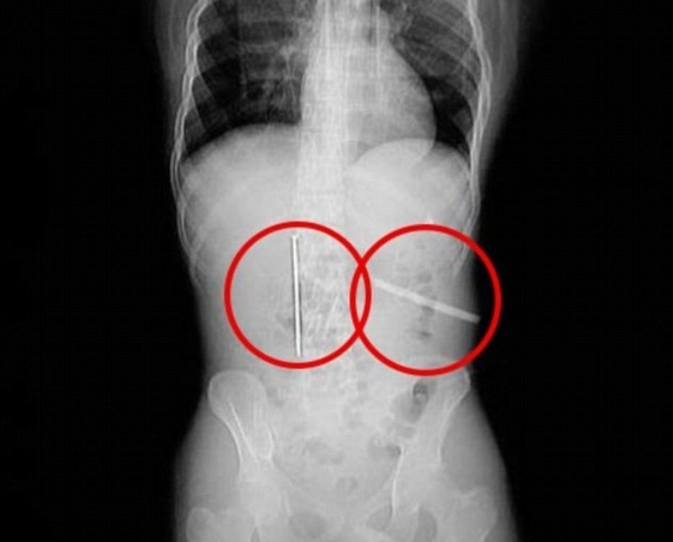 Ζούσε με ένα καρφί 8 εκατοστών μέσα στο κρανίο του και δεν μπορούσε να θυμηθεί ποιος του το… κάρφωσε  (Photos)  - Media